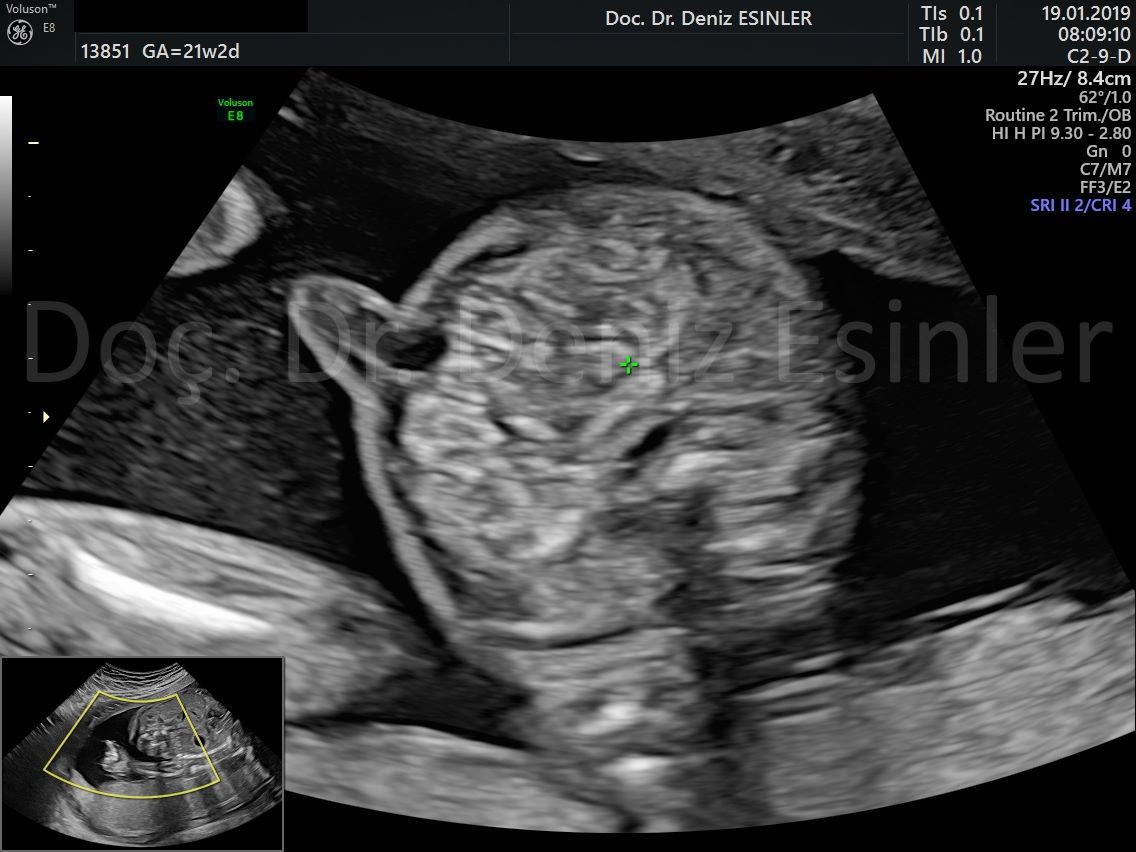 perinatoloji uzmani bayan kadin dogumcu riskli gebelik uzmani ankara detayli ultrason bebekte sakatlik taramasi 10
