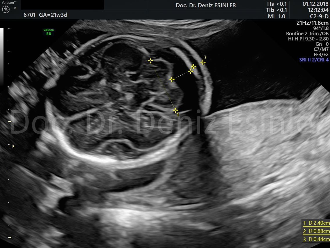 perinatoloji uzmani bayan kadin dogumcu riskli gebelik uzmani ankara detayli ultrason bebekte sakatlik taramasi 11