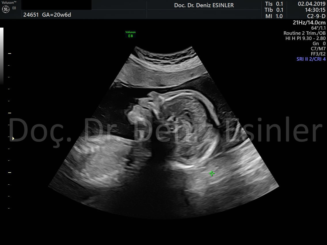perinatoloji uzmani bayan kadin dogumcu riskli gebelik uzmani ankara detayli ultrason bebekte sakatlik taramasi 12
