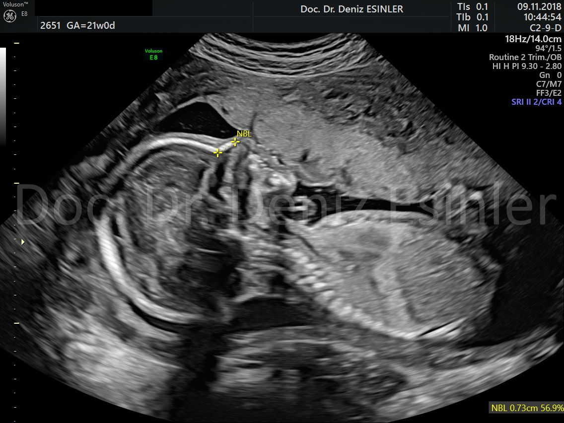 perinatoloji uzmani bayan kadin dogumcu riskli gebelik uzmani ankara detayli ultrason bebekte sakatlik taramasi 13