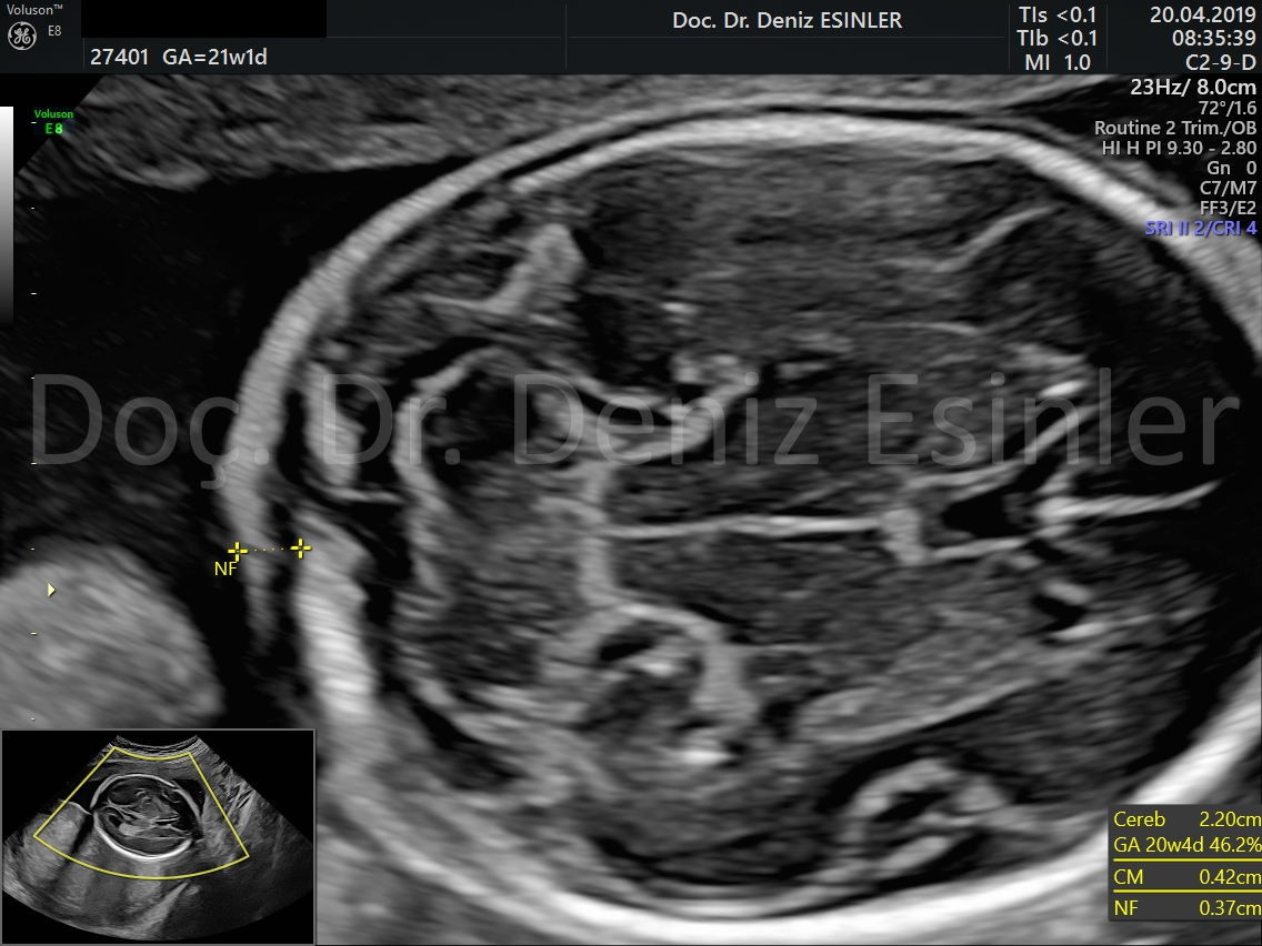perinatoloji uzmani bayan kadin dogumcu riskli gebelik uzmani ankara detayli ultrason bebekte sakatlik taramasi 15