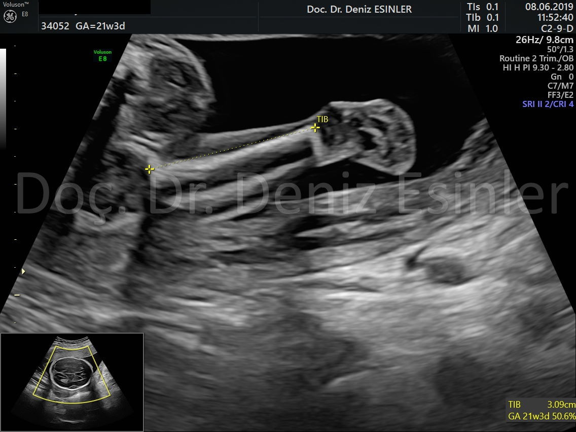 perinatoloji uzmani bayan kadin dogumcu riskli gebelik uzmani ankara detayli ultrason bebekte sakatlik taramasi 17