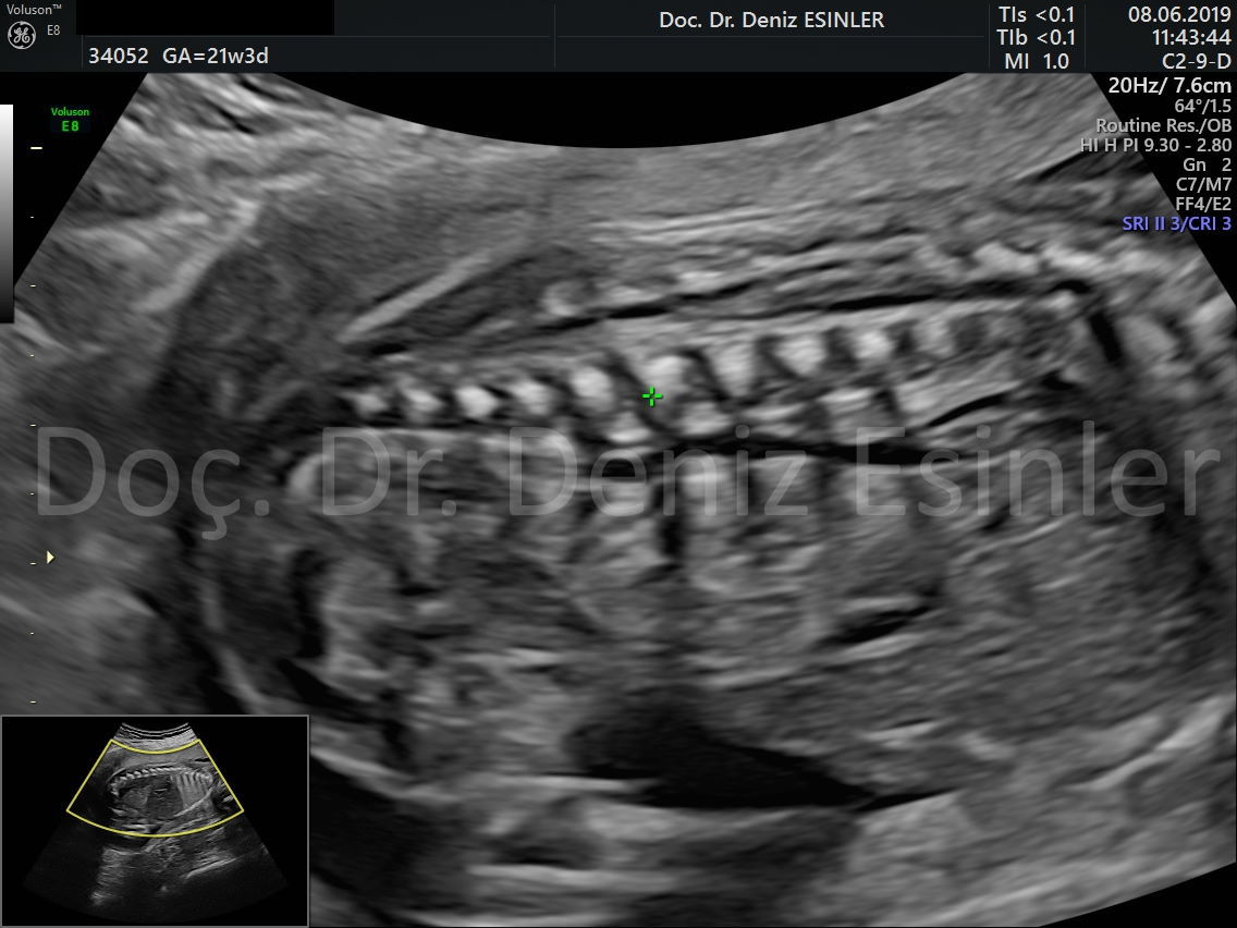perinatoloji uzmani bayan kadin dogumcu riskli gebelik uzmani ankara detayli ultrason bebekte sakatlik taramasi 18