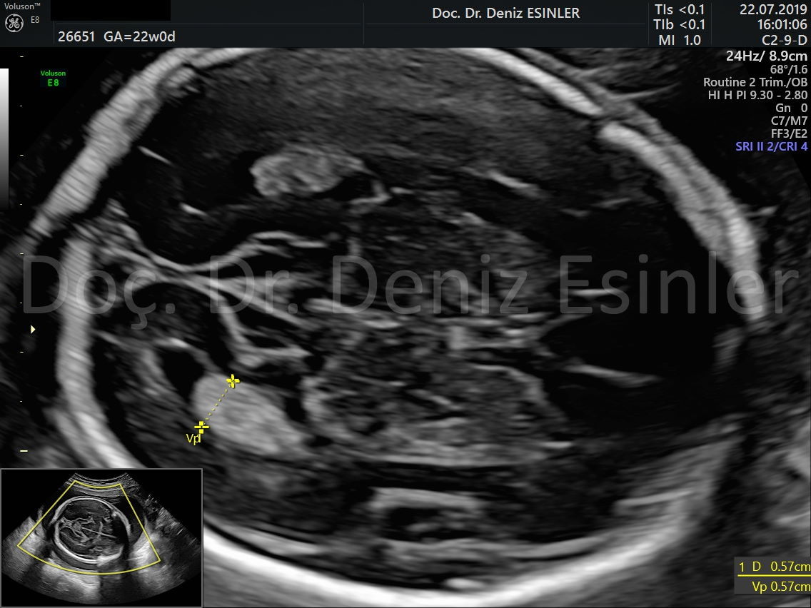 perinatoloji uzmani bayan kadin dogumcu riskli gebelik uzmani ankara detayli ultrason bebekte sakatlik taramasi 19