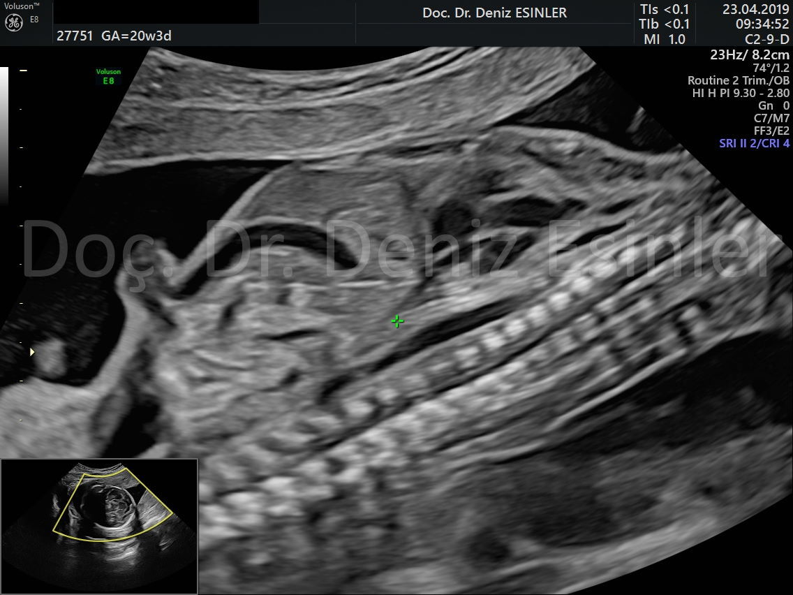 perinatoloji uzmani bayan kadin dogumcu riskli gebelik uzmani ankara detayli ultrason bebekte sakatlik taramasi 3