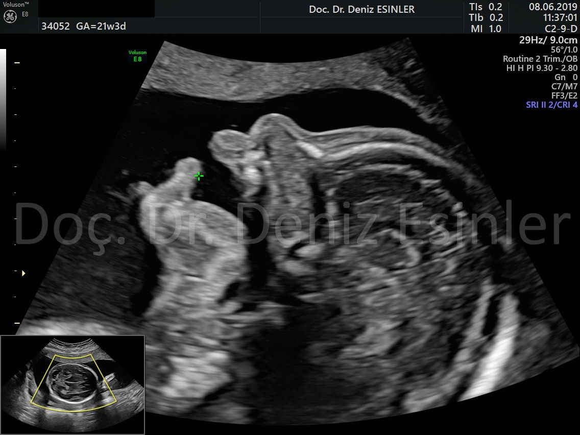 perinatoloji uzmani bayan kadin dogumcu riskli gebelik uzmani ankara detayli ultrason bebekte sakatlik taramasi 4
