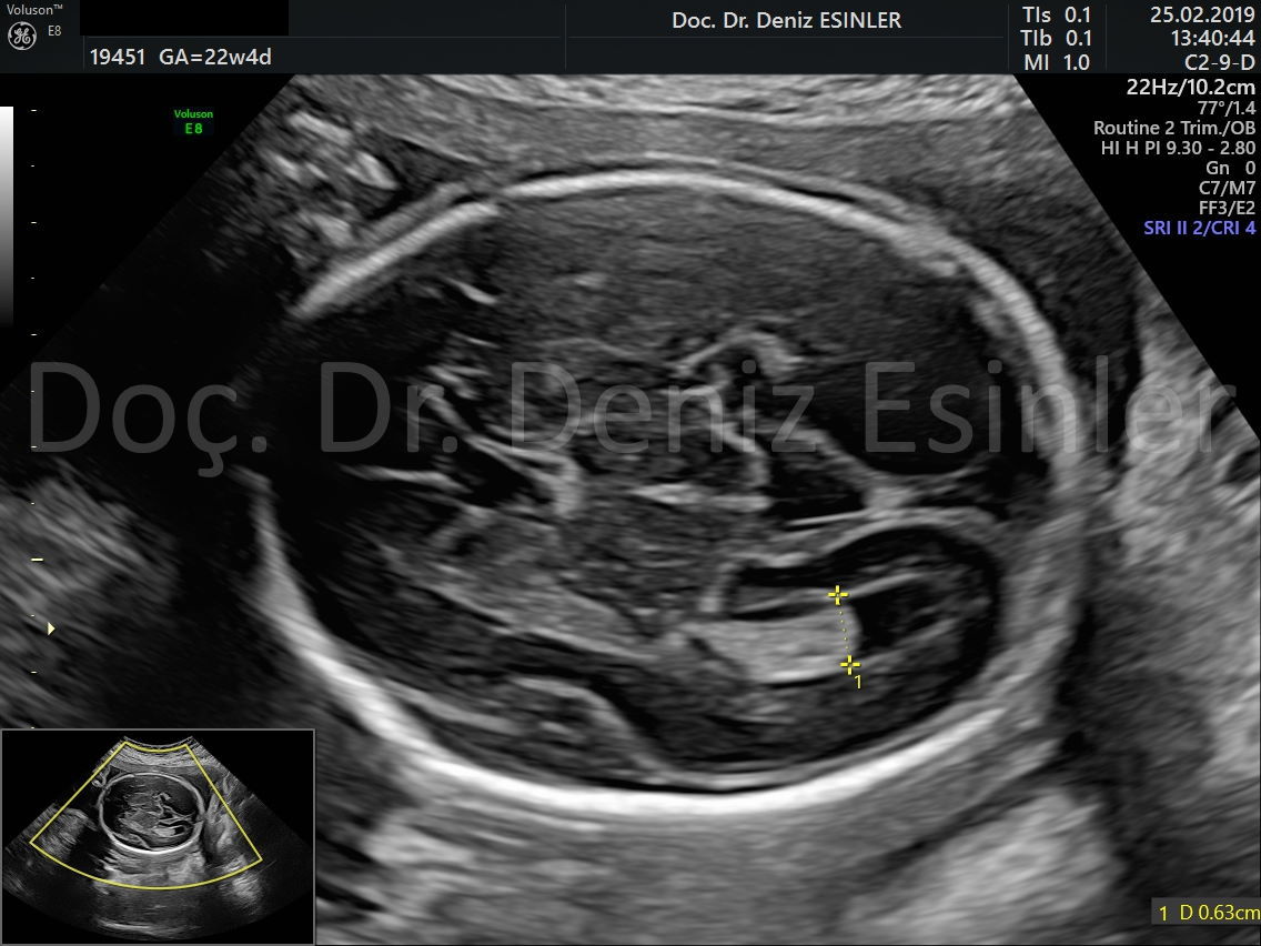 perinatoloji uzmani bayan kadin dogumcu riskli gebelik uzmani ankara detayli ultrason bebekte sakatlik taramasi 5
