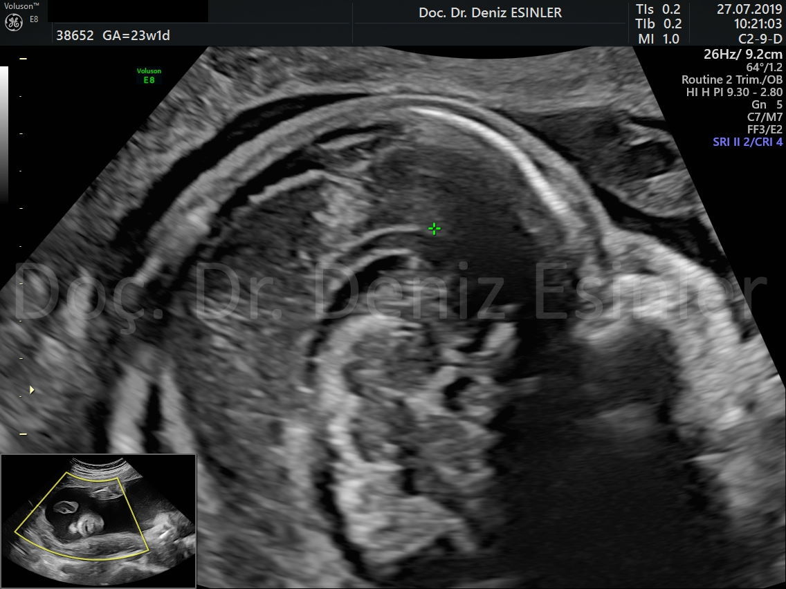 perinatoloji uzmani bayan kadin dogumcu riskli gebelik uzmani ankara detayli ultrason bebekte sakatlik taramasi 7