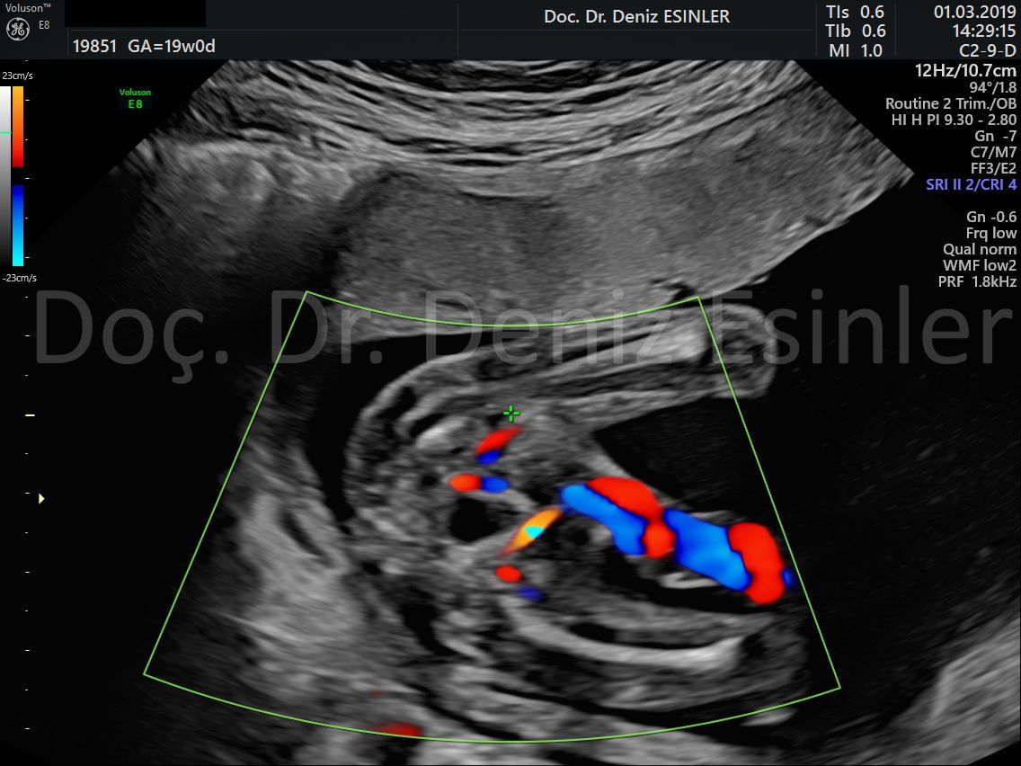perinatoloji uzmani bayan kadin dogumcu riskli gebelik uzmani ankara detayli ultrason bebekte sakatlik taramasi 8
