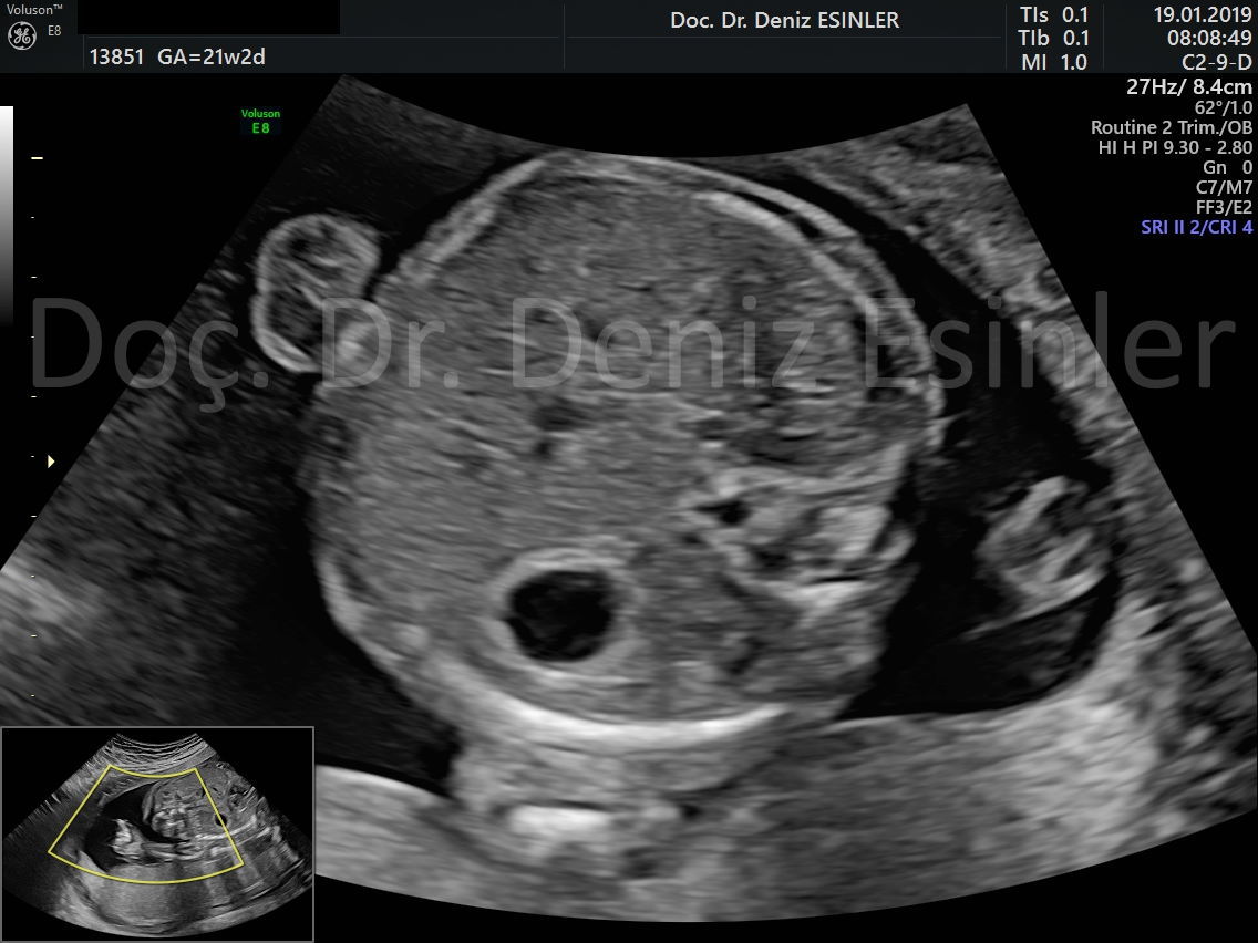 perinatoloji uzmani bayan kadin dogumcu riskli gebelik uzmani ankara detayli ultrason bebekte sakatlik taramasi 9