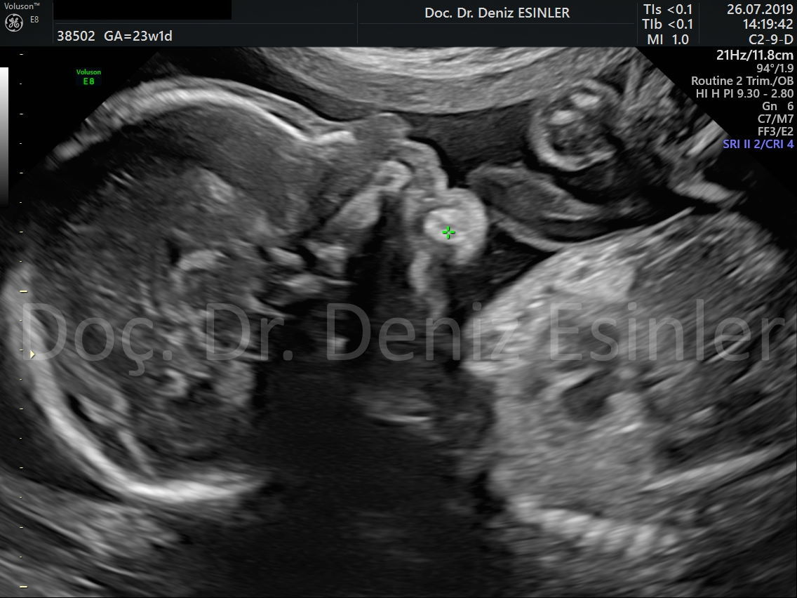 perinatoloji uzmani bayan kadin dogumcu riskli gebelik uzmani ankara detayli ultrason bebekte sakatlik taramasi kadin dogum uzmani 1
