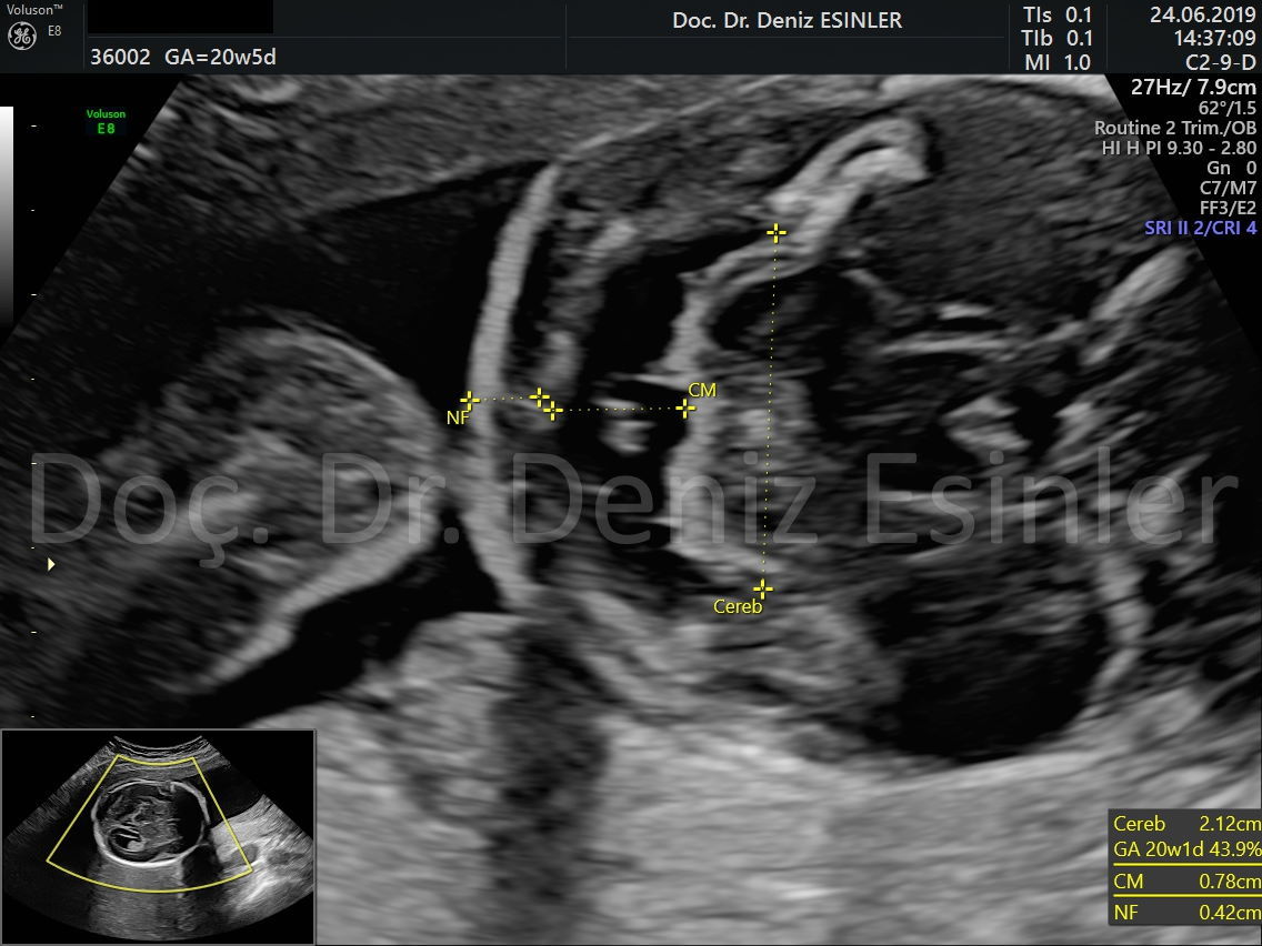perinatoloji uzmani bayan kadin dogumcu riskli gebelik uzmani ankara detayli ultrason bebekte sakatlik taramasi 2