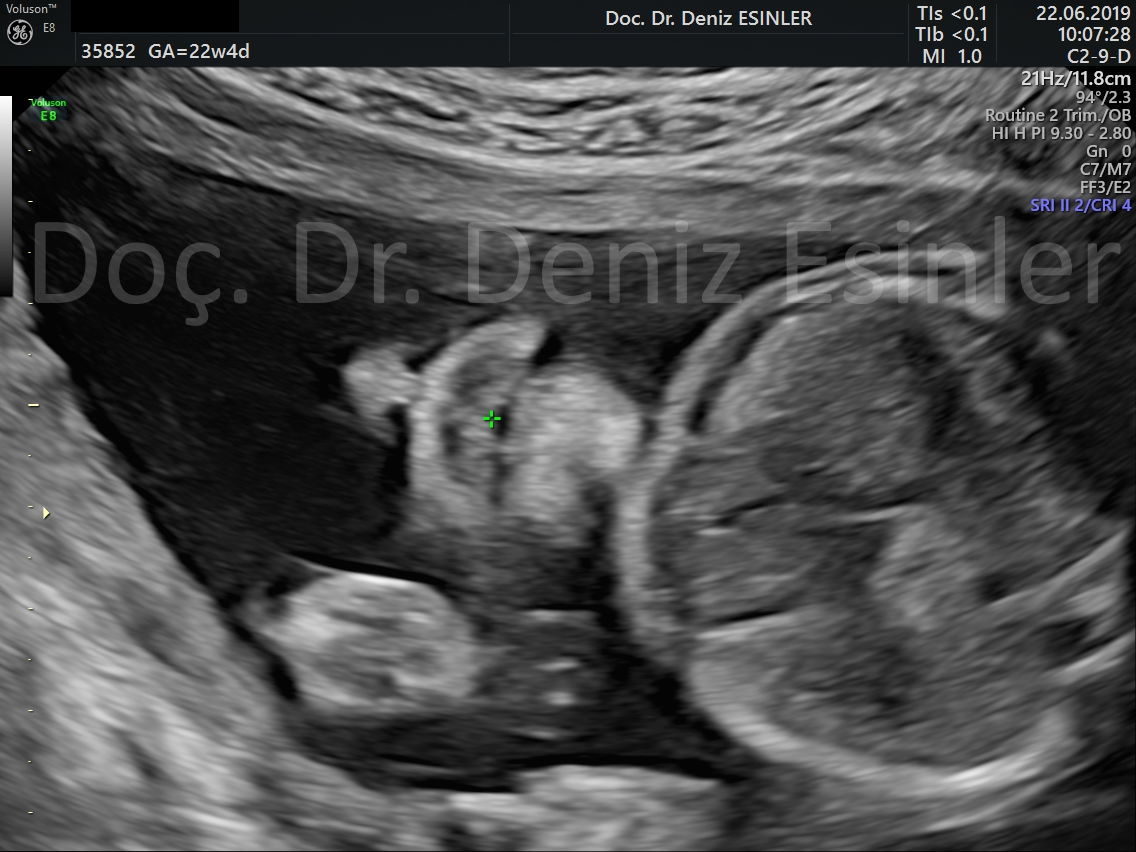 perinatoloji uzmani bayan kadin dogumcu riskli gebelik uzmani ankara detayli ultrason bebekte sakatlik taramasi 6